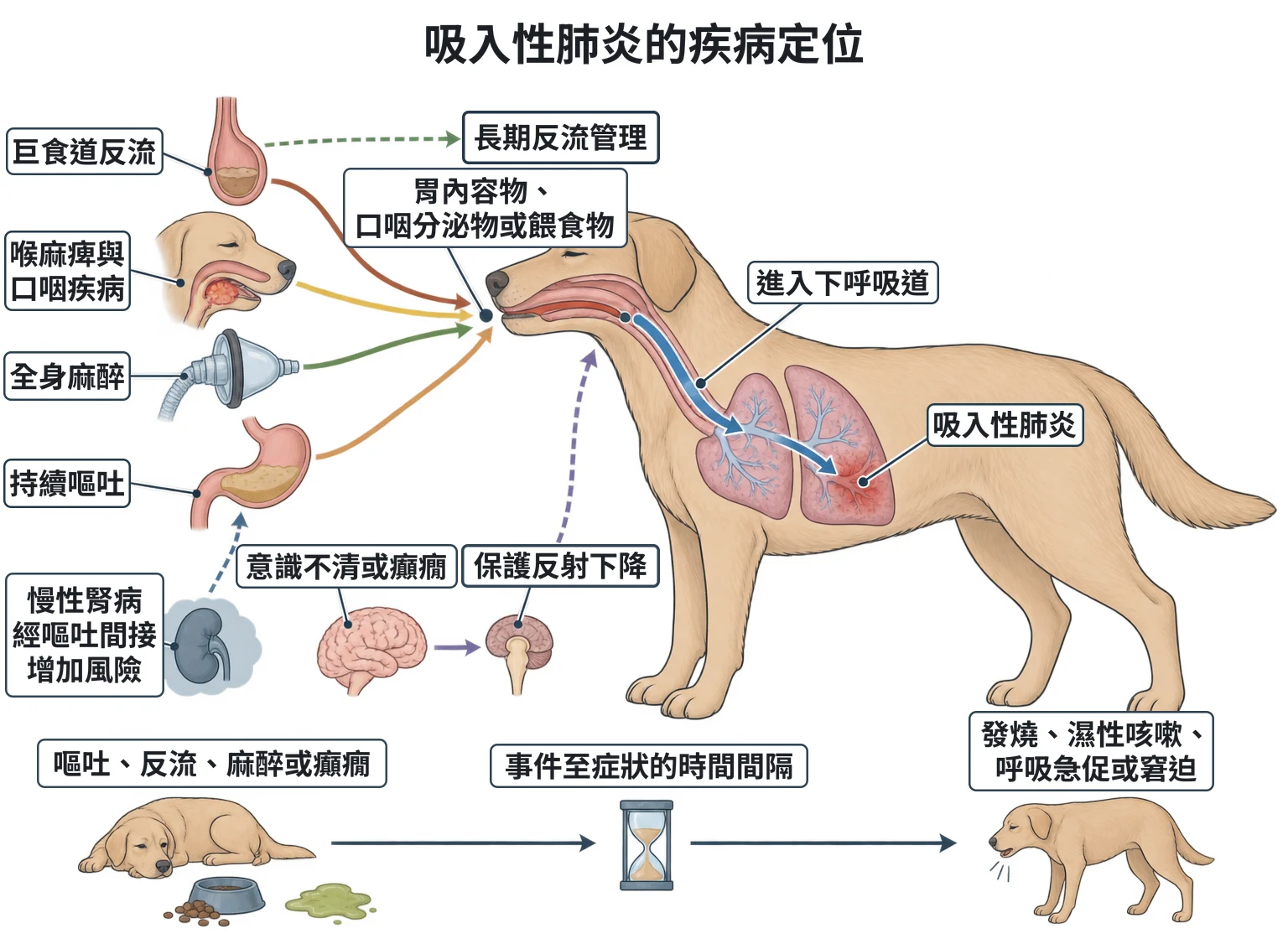 吸入性肺炎的疾病定位教學插圖