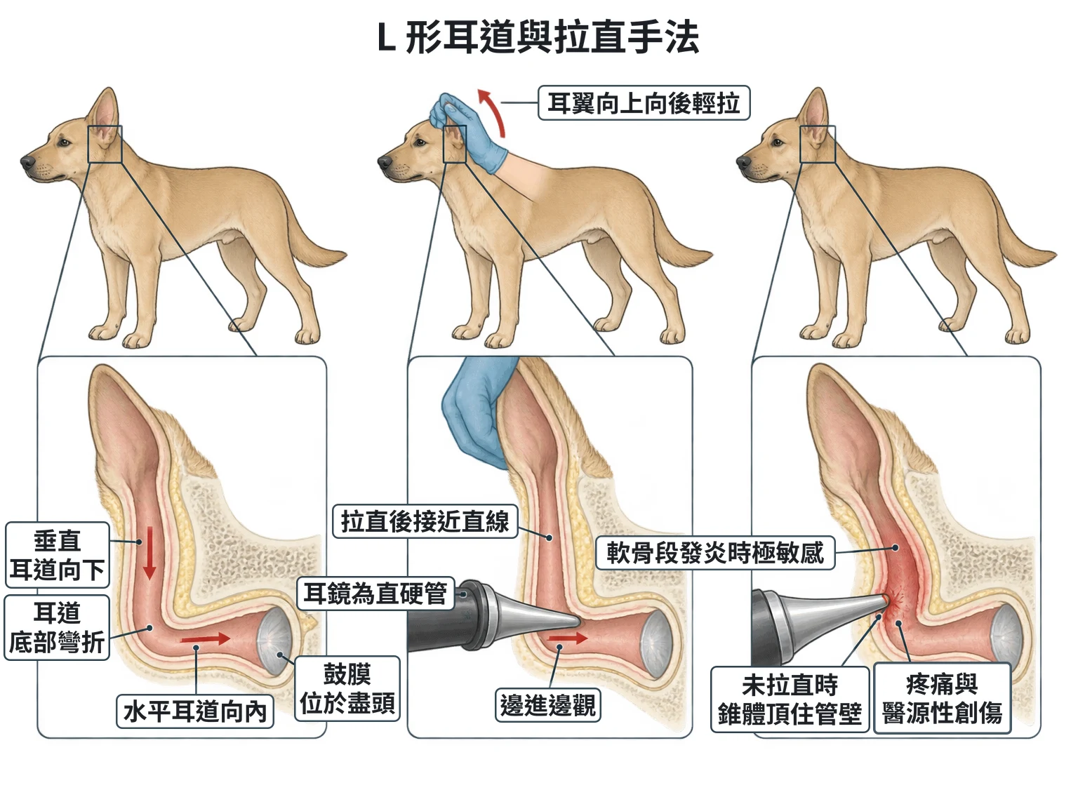 L 形耳道與拉直手法教學插圖