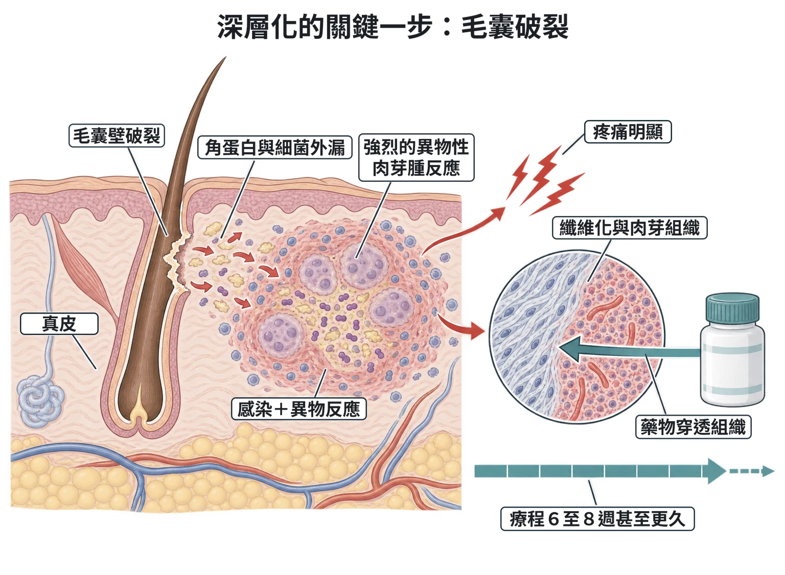 深層化的關鍵一步:毛囊破裂教學插圖