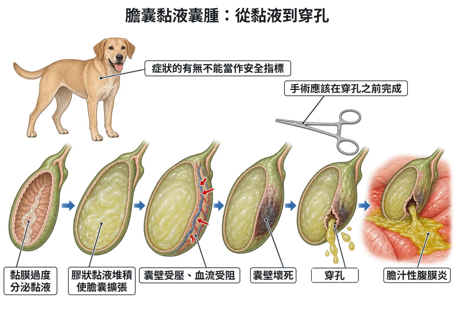 膽囊黏液囊腫:從黏液到穿孔教學插圖