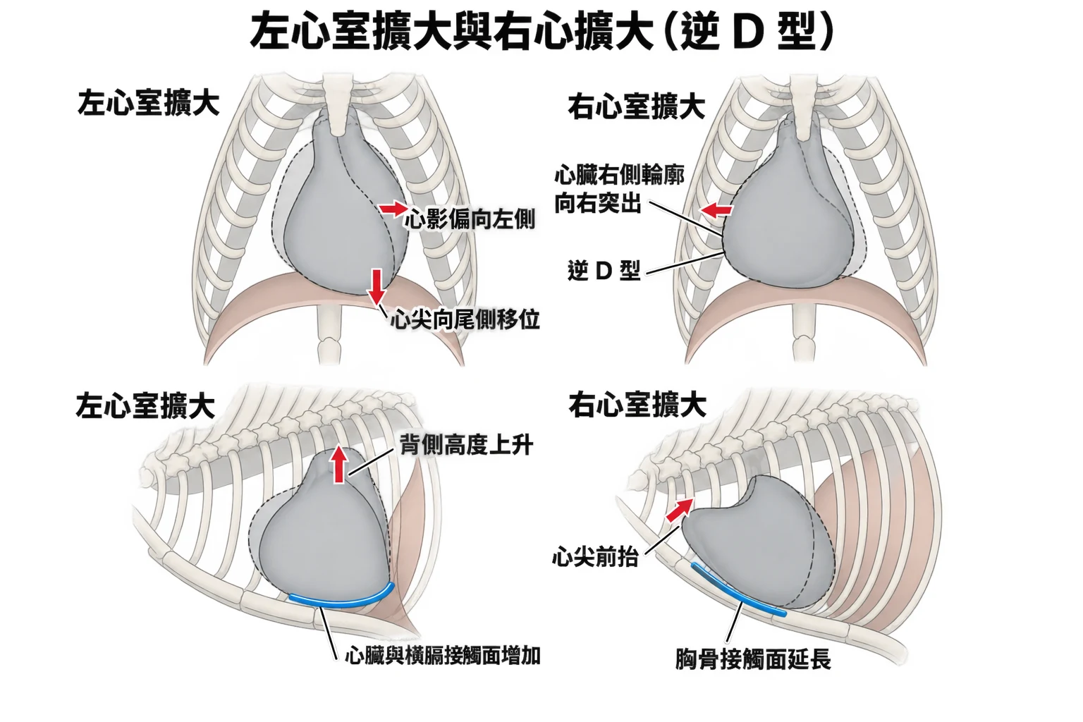 左心室擴大與右心擴大(逆 D 型)教學插圖