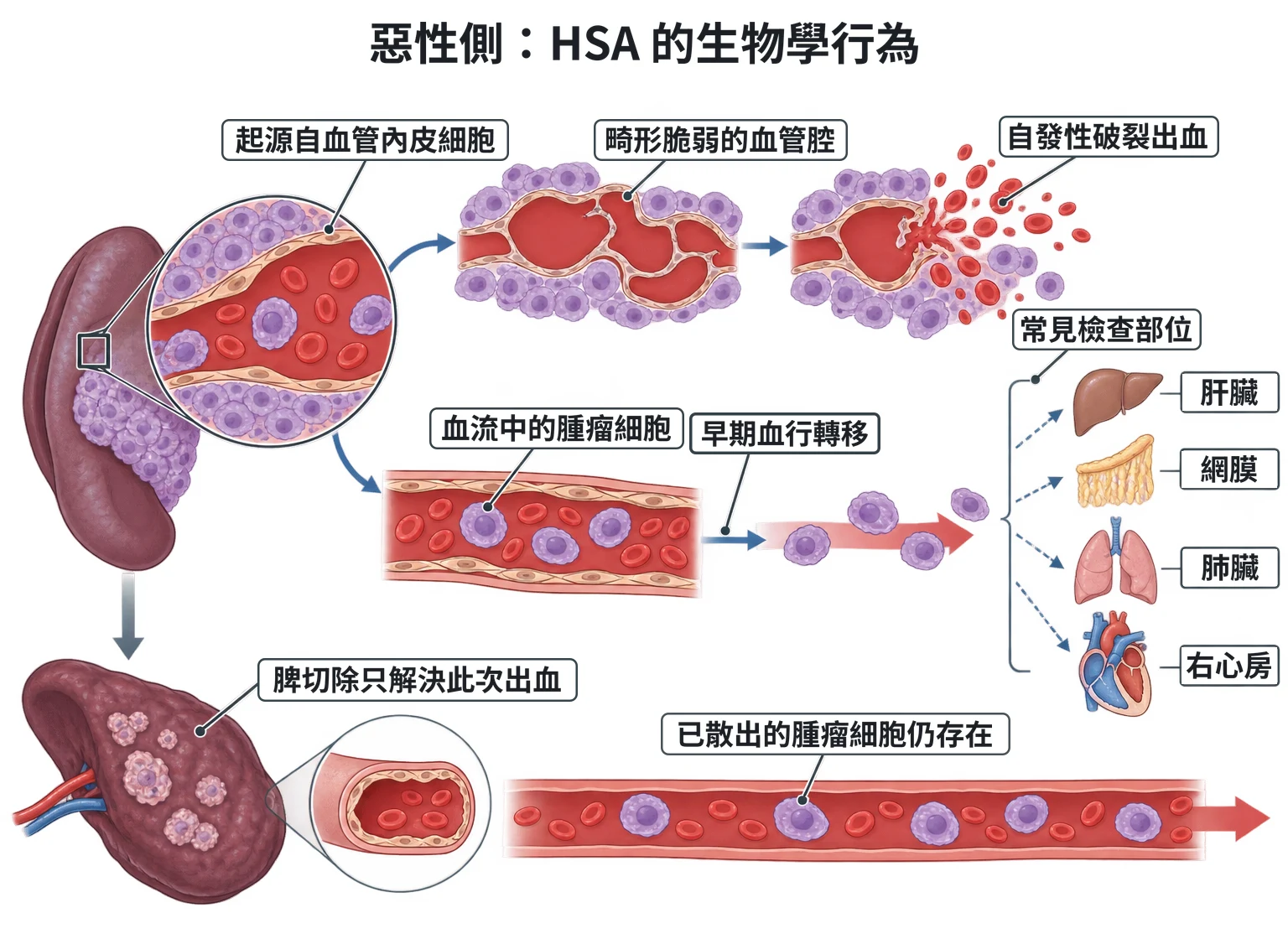 惡性側:HSA 的生物學行為教學插圖
