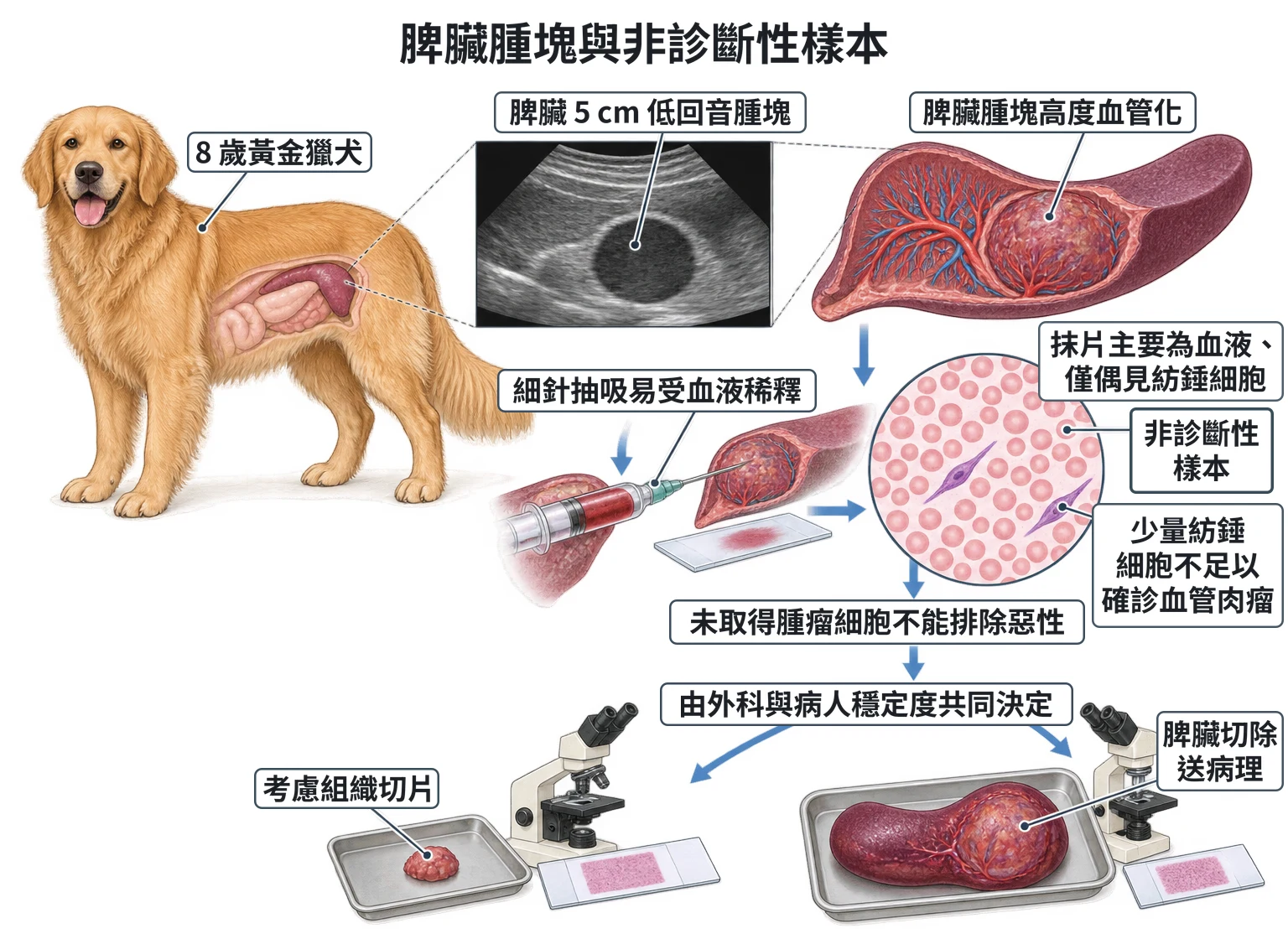 脾臟腫塊與非診斷性樣本教學插圖