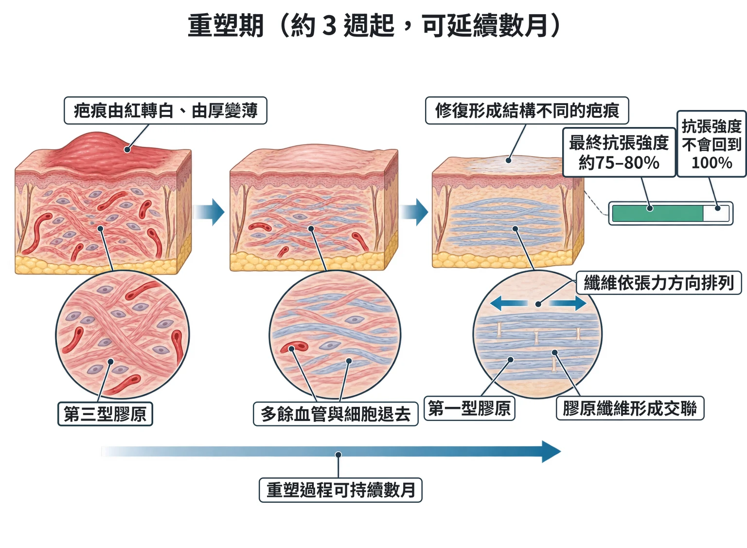 重塑期(約 3 週起,可延續數月)教學插圖
