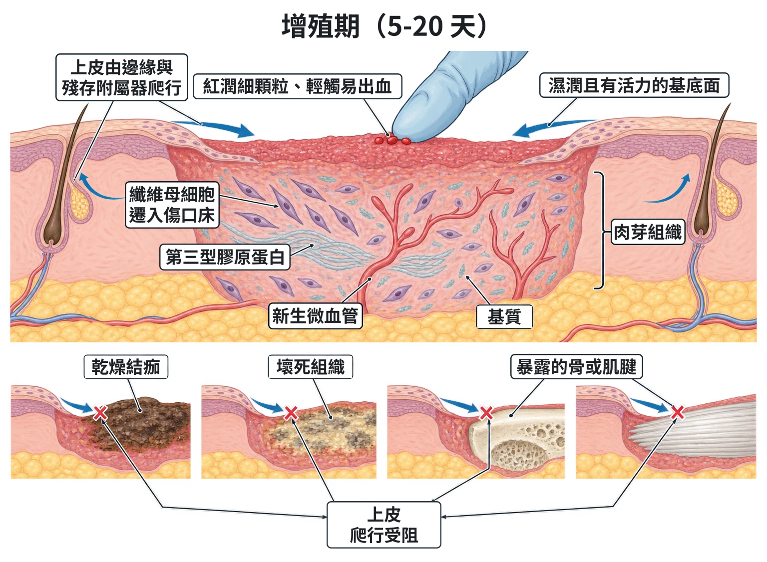增殖期(5-20 天)教學插圖