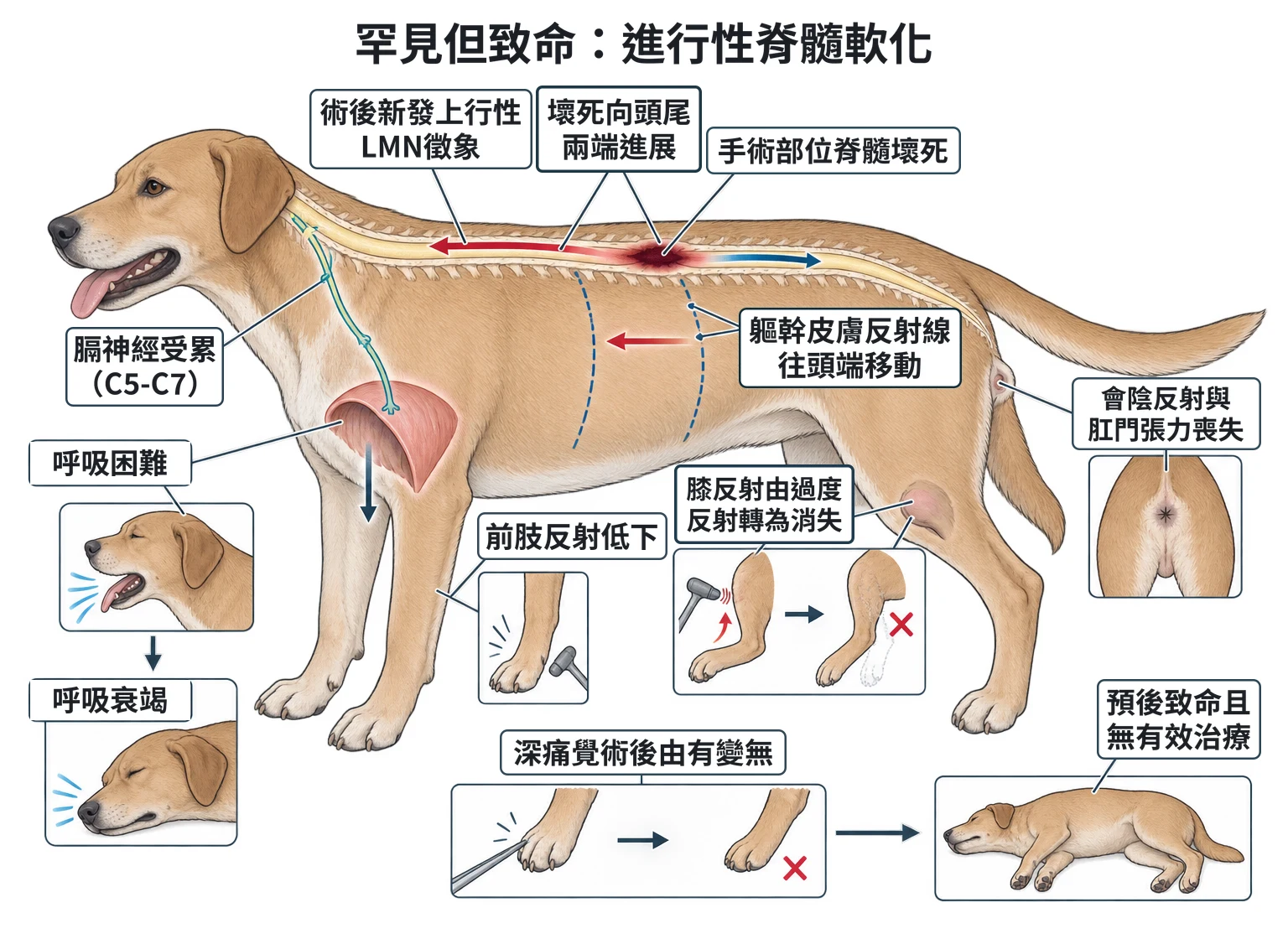 罕見但致命:進行性脊髓軟化教學插圖