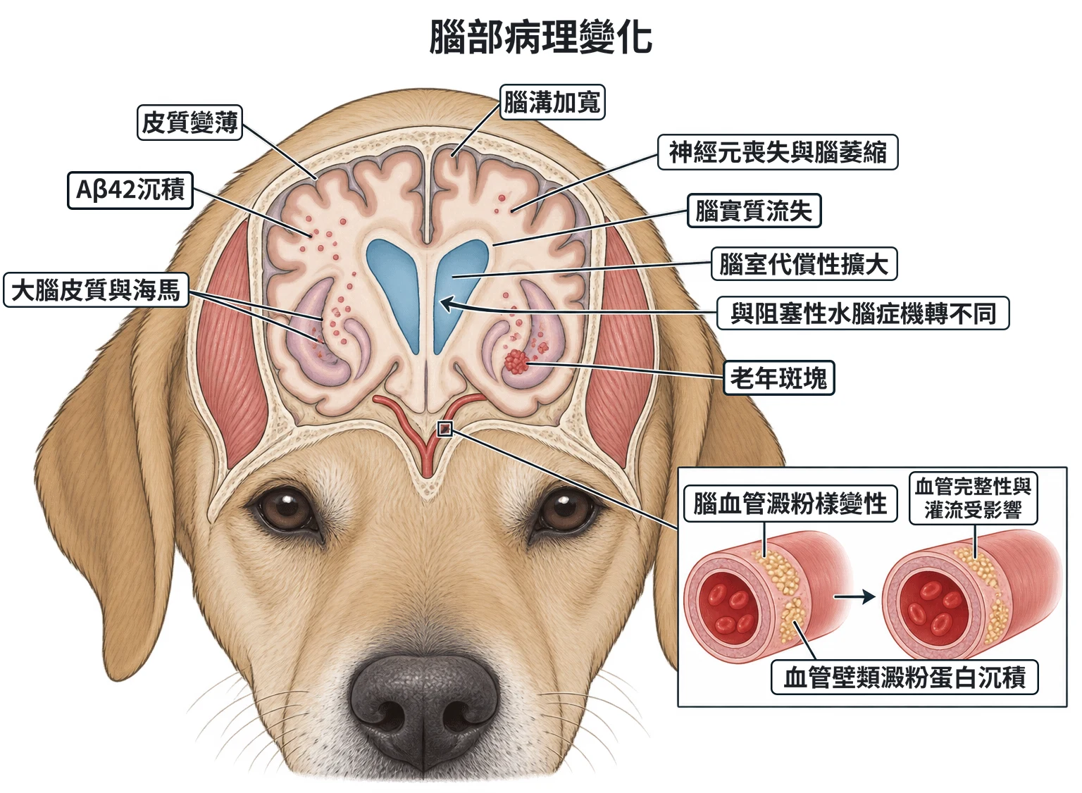 腦部病理變化教學插圖
